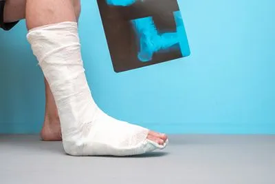 Man with a cast holding an X-ray of his fractured ankle