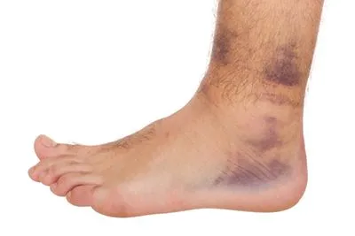 Close-up of ankle sprain with visible swelling and bruising