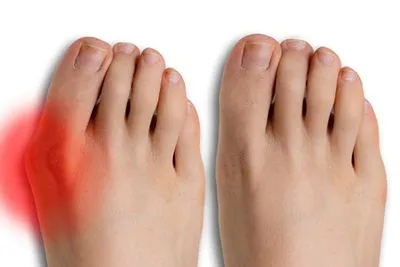 Before and after bunionectomy results showing improvement in big toe alignment