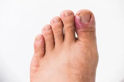 Illustration of ingrown toenail on person foot
