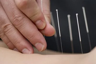 acupuncture treatment 