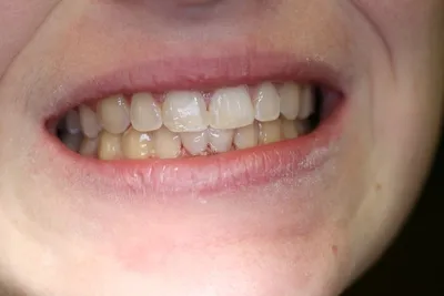 teeth_pics_008.JPG