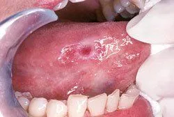 dentist North York, ON examining mouth and tongue for signs of oral cancer