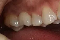 Dental Implants After Portage, MI