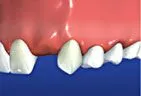 illustration of teeth and gums with one missing tooth, dental bridge Gardnerville, NV