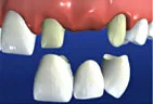 illustration of 3 unit dental bridge being placed over adjacent teeth to replace missing tooth, family dentist Gardnerville, NV