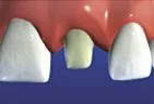 illustration showing prepared tooth ready for dental crown to be placed, same day crowns Gardnerville, NV