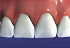 illustration showing restored tooth after dental crown is placed to cover damage, dental crown Gardnerville, NV dentist