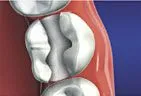 tooth structure after area of decay removed by dentist Gardnerville, NV