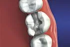 teeth with metal dental fillings Gardnerville, NV dentist