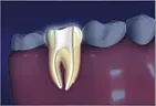 tooth showing root canals, Gardnerville, NV