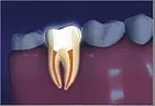 tooth interior after root canal, no infection, filling in tooth. dentist Gardnerville, NV