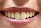 yellowed teeth before whitening treatment using custom trays, professional teeth whitening Gardnerville, NV dentist