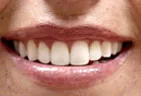 whiter teeth after professional teeth whitening treatment, family dentist Gardnerville, NV