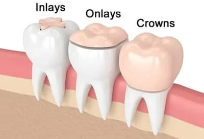Fort Myers Dental Inlays and Onlays