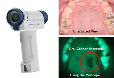VELScope Oral Cancer Screening