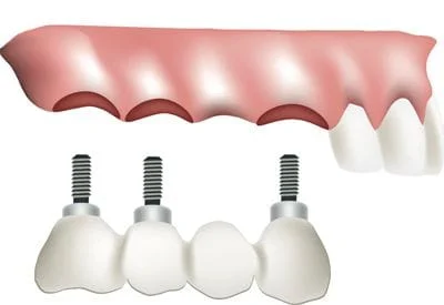 pdm_dental-implant-bridge