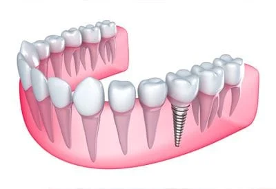 Dental Implants Fountain Valley