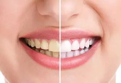 Devki Adi  Invisalign Treatment in Fort Myers