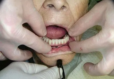 Dental Implants with Screw Retained Denture