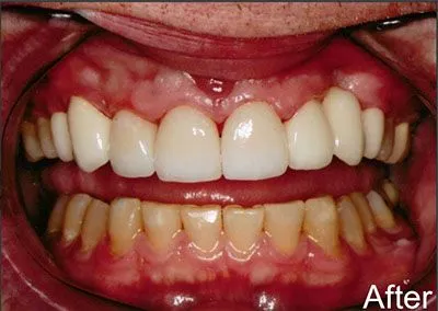 Anterior Veneers and Crowns