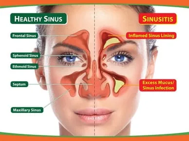 sinus disease