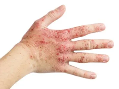 Close-up of hand affected by eczema on white background