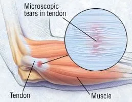 elbow tendonitis illustration