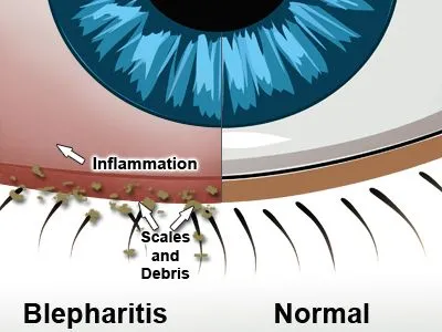 blephartis treatment