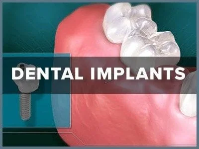 dental_implants
