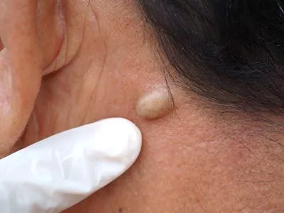Dermatologist examining skin before cyst removal
