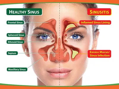 Sinus drainage deals symptoms