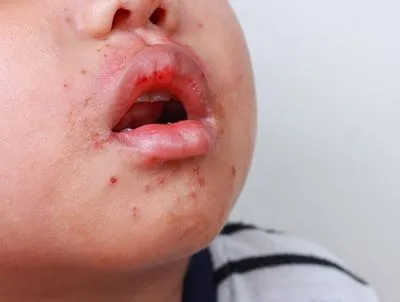 Close-up of oral blisters in a child with HFMD