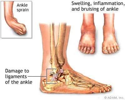 Image result for ankle sprain