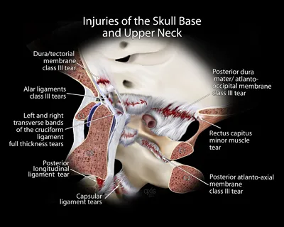 Cranio Servical Injury