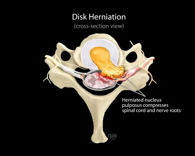 Disk Herniation