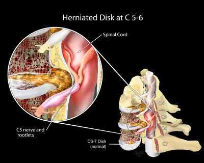 Herniated Disk at C 5-6