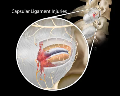 Capsular Ligament Injuries