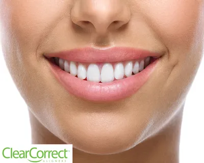 Before & After ClearCorrect Aligners