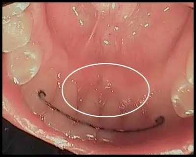 Tongue Piercing_Pre-Flap Surgery_Bone Grafting_F. Neal Pylant, Periodontist