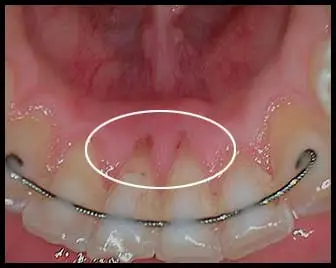 Tongue Piercing_Pre-Flap Surgery_Bone Grafting_F. Neal Pylant, Periodontist