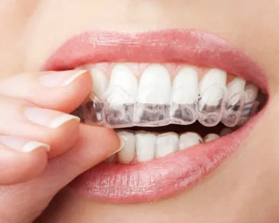 insurance cover Invisalign