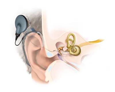 Cochlear Implants