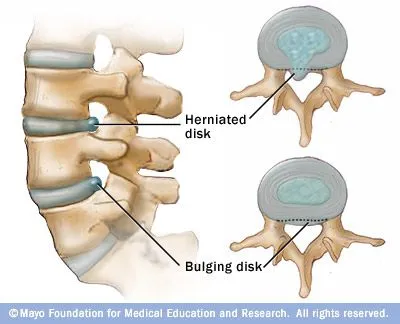 Herniated Disc, Bangor, Ellsworth