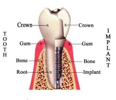 Implants 