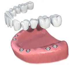 multiple dental implants