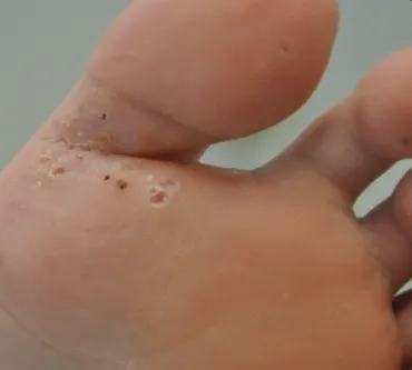 Wart after laser treatment