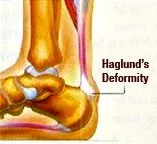 Haglunds_Deformity1.jpg