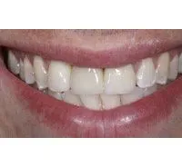 After Dental Implants