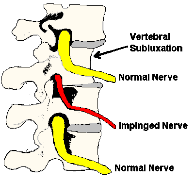Subluxation, Modesto Chiropractic, Modesto Chiropractor, back pain, neck pain
